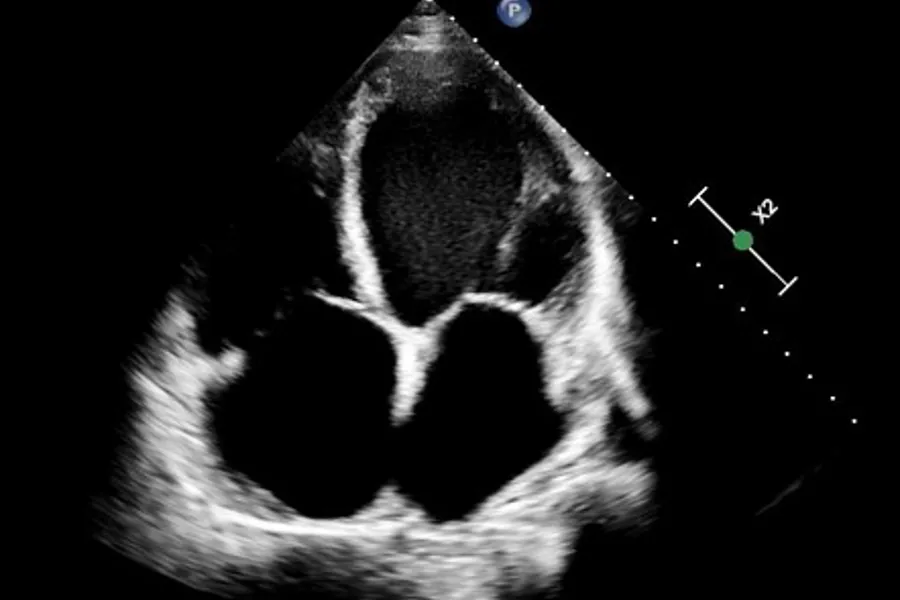 Dilated cardiomyopathy (DCM) in an apical 4-chamber view on cardiac ultrasound