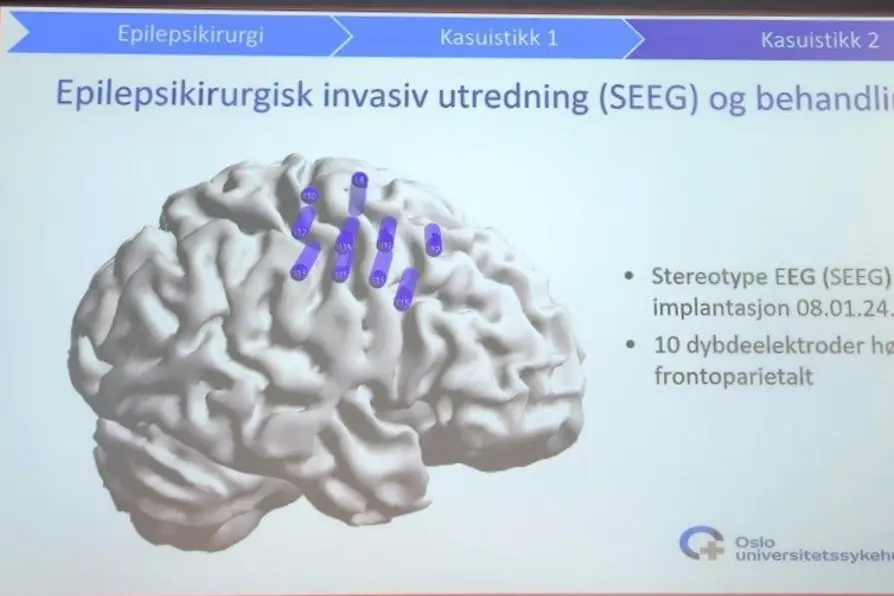 Illustrasjon av en hjerne med 10 elektroder under SEEG-utredning