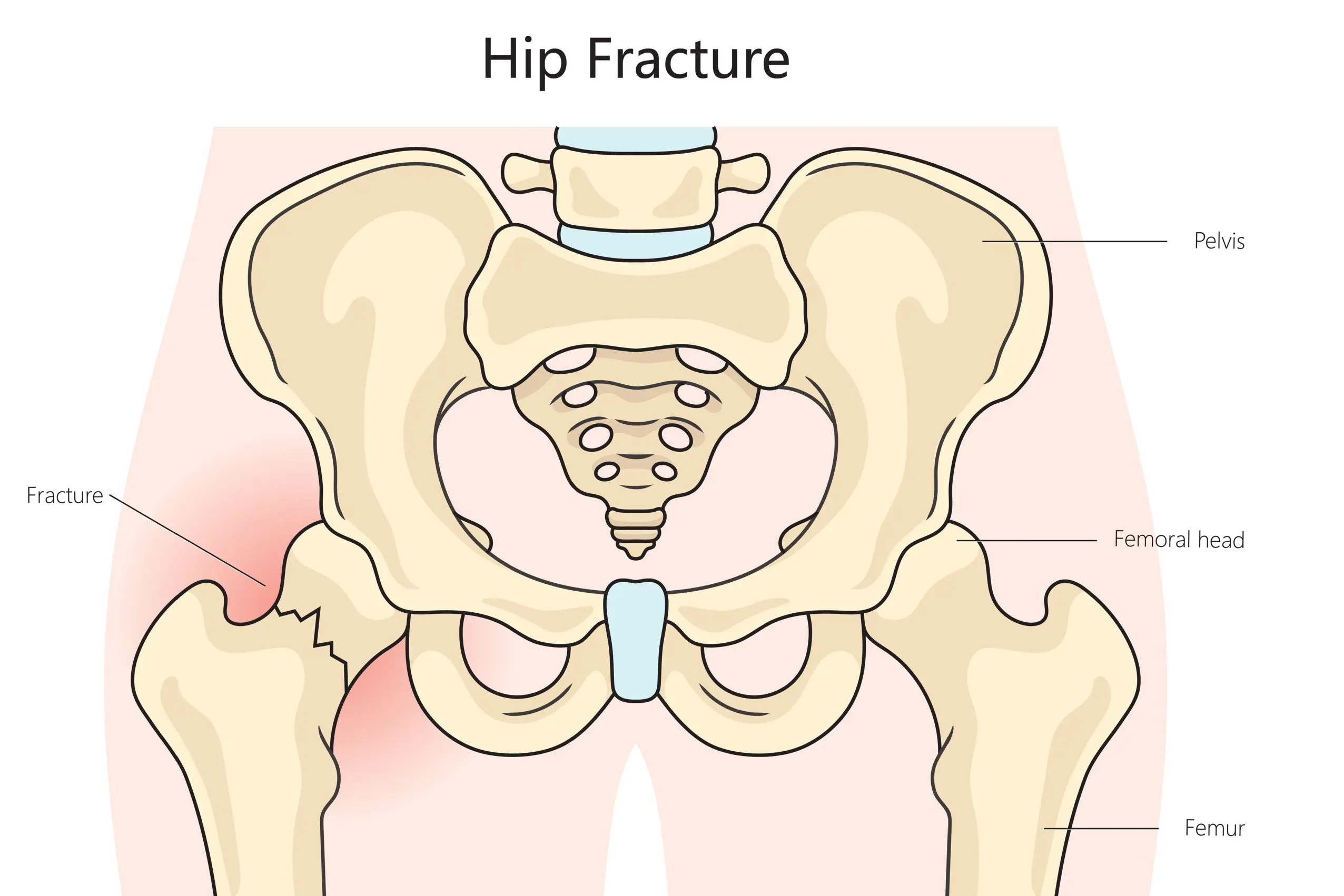 Diagram hoftebrudd